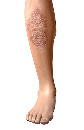skin disease - Pyoderma gangrenosum Stock Photo - Premium Royalty-Free, Code: 671-02098916