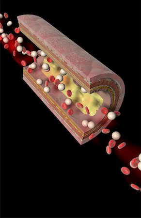 Atheromatöse plaque Stockbilder - Premium RF Lizenzfrei, Bildnummer: 671-02099652