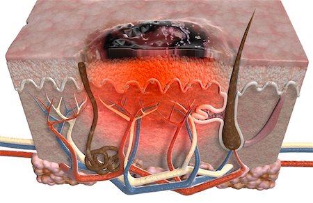 simsearch:671-02098689,k - Malignes Melanom Stockbilder - Premium RF Lizenzfrei, Bildnummer: 671-02100174