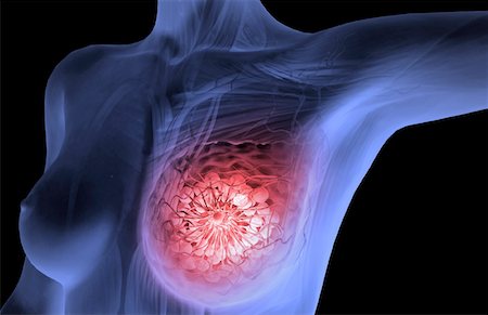 Breast cancer Fotografie stock - Premium Royalty-Free, Codice: 671-02101642