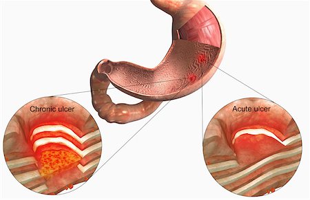détail microscopique - Ulcère de l'estomac Photographie de stock - Premium Libres de Droits, Code: 671-02101753