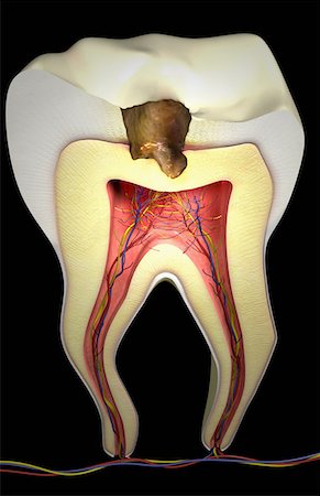 dolor de muelas - Tooth decay Foto de stock - Sin royalties Premium, Código: 671-02101806