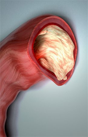 Verstopften aorta Stockbilder - Premium RF Lizenzfrei, Bildnummer: 671-02102297