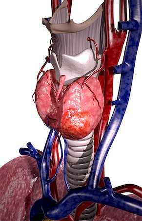 Cancer de la thyroïde Photographie de stock - Premium Libres de Droits, Code: 671-02102815