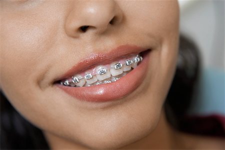 simsearch:693-06014951,k - Teenage Girl (14-16) wearing teeth braces, (close-up) Stock Photo - Premium Royalty-Free, Code: 693-06014941