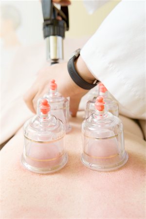 Chinese traditional cupping therapy for improved circulation Stock Photo - Premium Royalty-Free, Code: 693-06022057