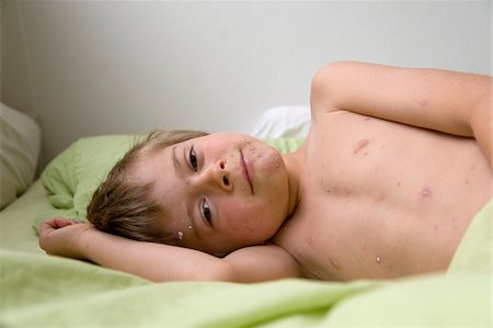 Boy with Chicken Pox Lying in Bed Foto de stock - Con derechos protegidos, Código: 700-05969977