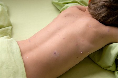 photo of a white boy on sick bed - Boy with Chicken Pox Lying in Bed Stock Photo - Rights-Managed, Code: 700-05969979