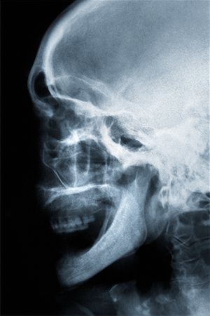 simsearch:700-00150546,k - Skull X-Ray Stock Photo - Rights-Managed, Code: 700-00094787