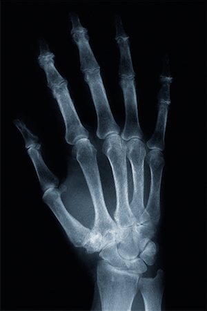 simsearch:700-00150546,k - X-Ray of Hand Foto de stock - Direito Controlado, Número: 700-00150547