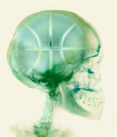 simsearch:700-00150546,k - X-Ray of Skull with Basketball Stock Photo - Rights-Managed, Code: 700-00163300