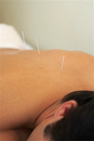 simsearch:700-00609553,k - Acupuncture Fotografie stock - Rights-Managed, Codice: 700-00609548