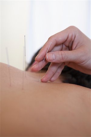 simsearch:700-00609553,k - Acupuncture Fotografie stock - Rights-Managed, Codice: 700-00609556