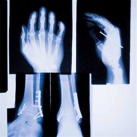 X-Rays of Hands and Ankles Foto de stock - Direito Controlado, Número: 700-02232006