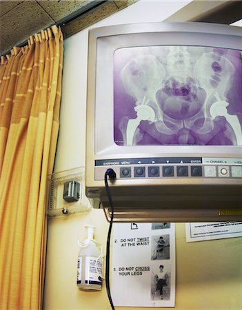 X-Ray on Monitor in Hospital Room Stock Photo - Rights-Managed, Code: 700-03458208