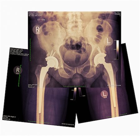 pelvis - X-rays showing Double Hip Replacement Stock Photo - Rights-Managed, Code: 700-03466375