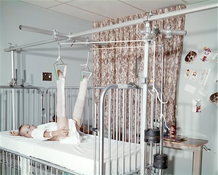 fracture - JAMBES ENFANT TRACTION HOSPITALIERE CASSÉ DES ANNÉES 1970 À LA RUPTURE Photographie de stock - Rights-Managed, Code: 846-02794622