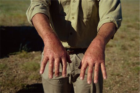 Tourist's hands with mosquito bites, Namibia, Africa Foto de stock - Direito Controlado, Número: 841-02918248